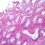 ulcerative colitis