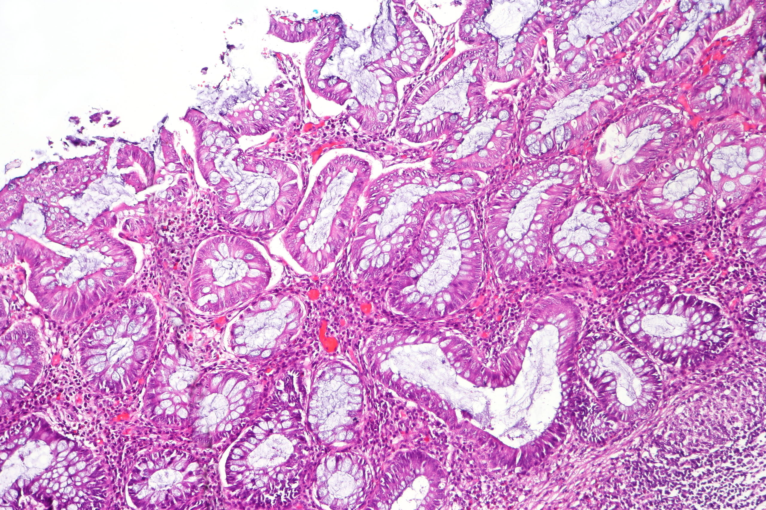 ulcerative colitis